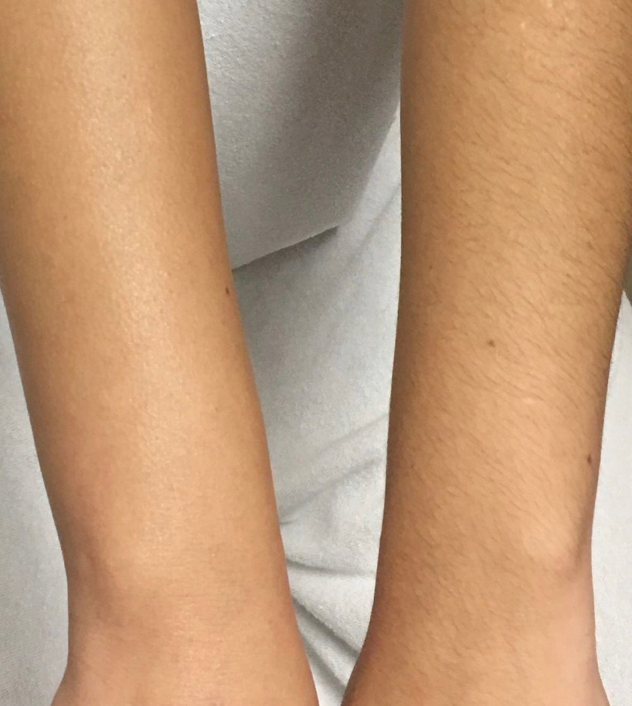 Half Arms
