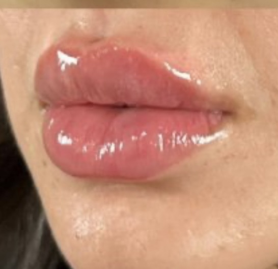 Lip Filler