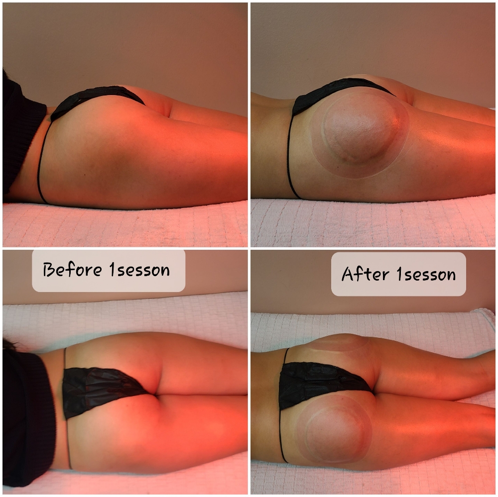 BBL Vacuum Therapy 1session