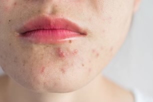 Acne Consultation & Treatment
