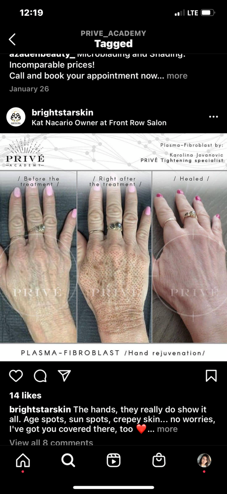 Hand Plasma Lift