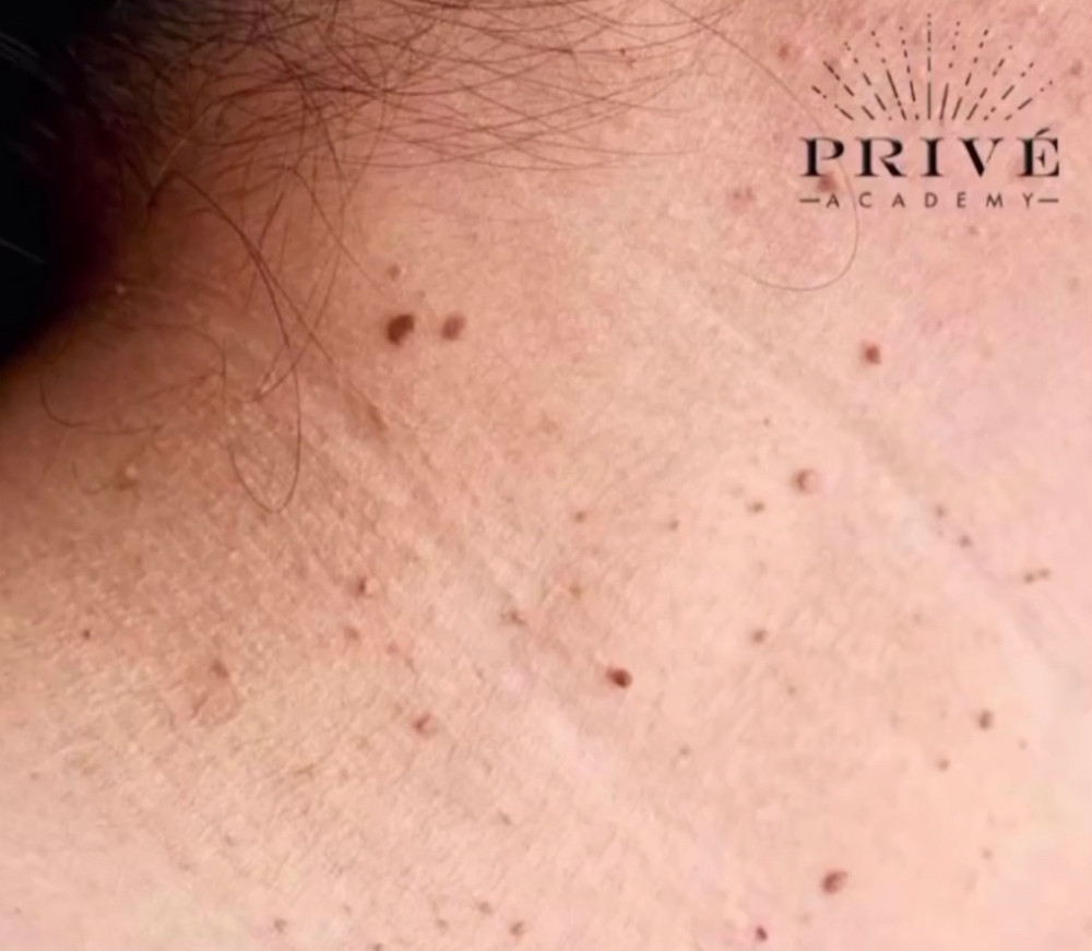 Fibroblast Skin Tag Removal