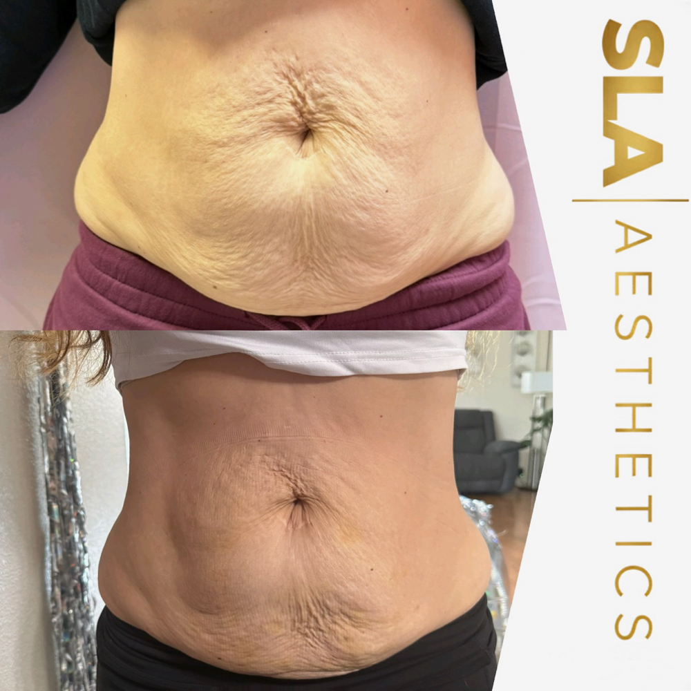 Ultrasound Tightening / Lift / Fat at Self Love Aesthetics in Corning, CA