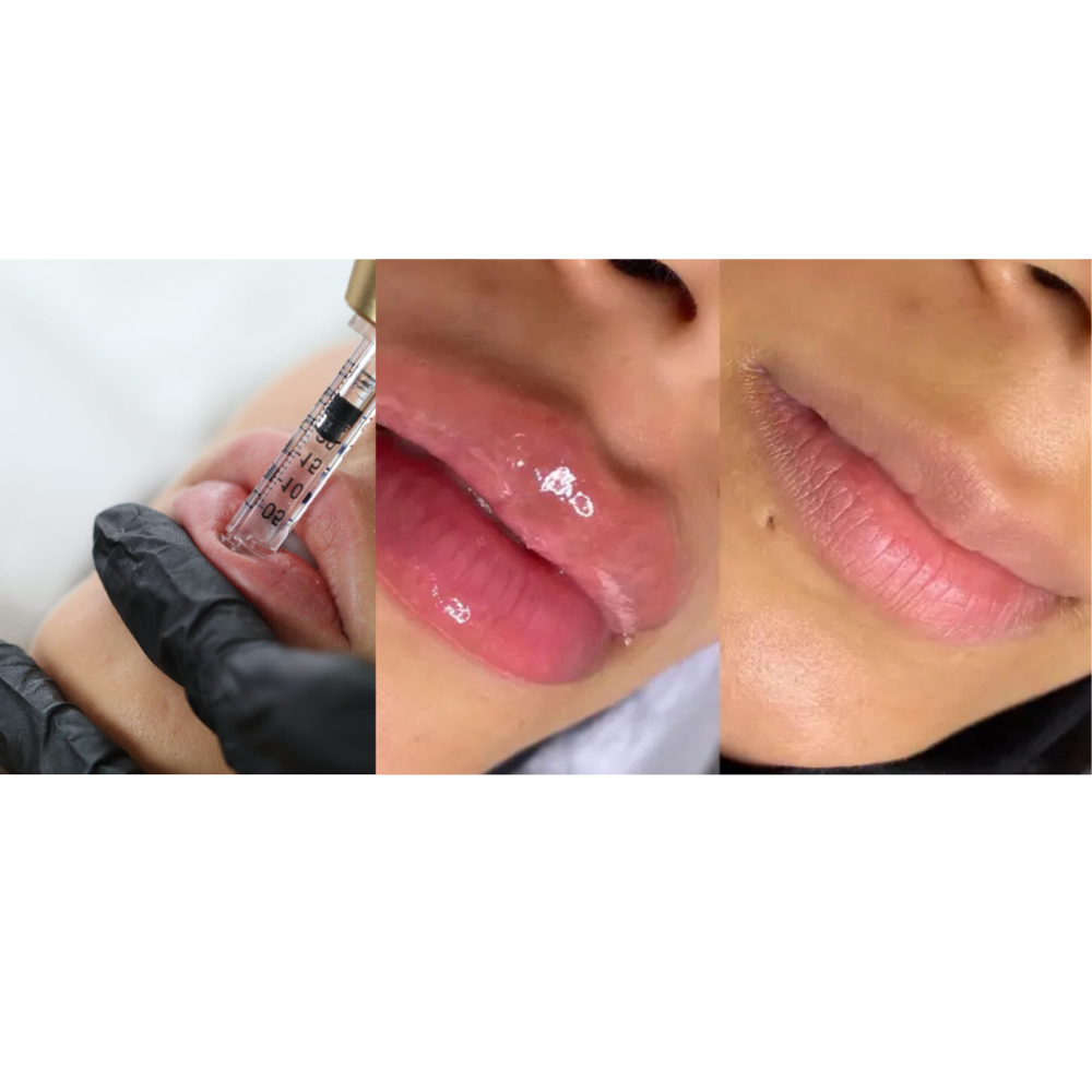 NEEDLESS LIP FILLER HYALURON PEN