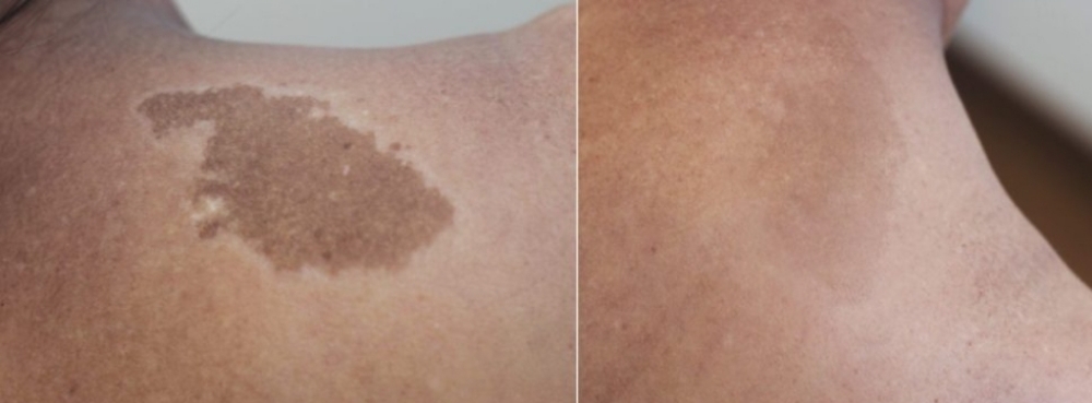 Scar/Birthmark Micropigmentation