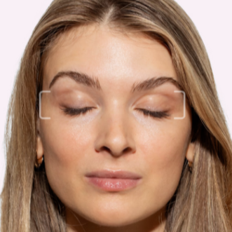 Crow's Feet Tox at Injections by Leighanna in Clarksville, IN