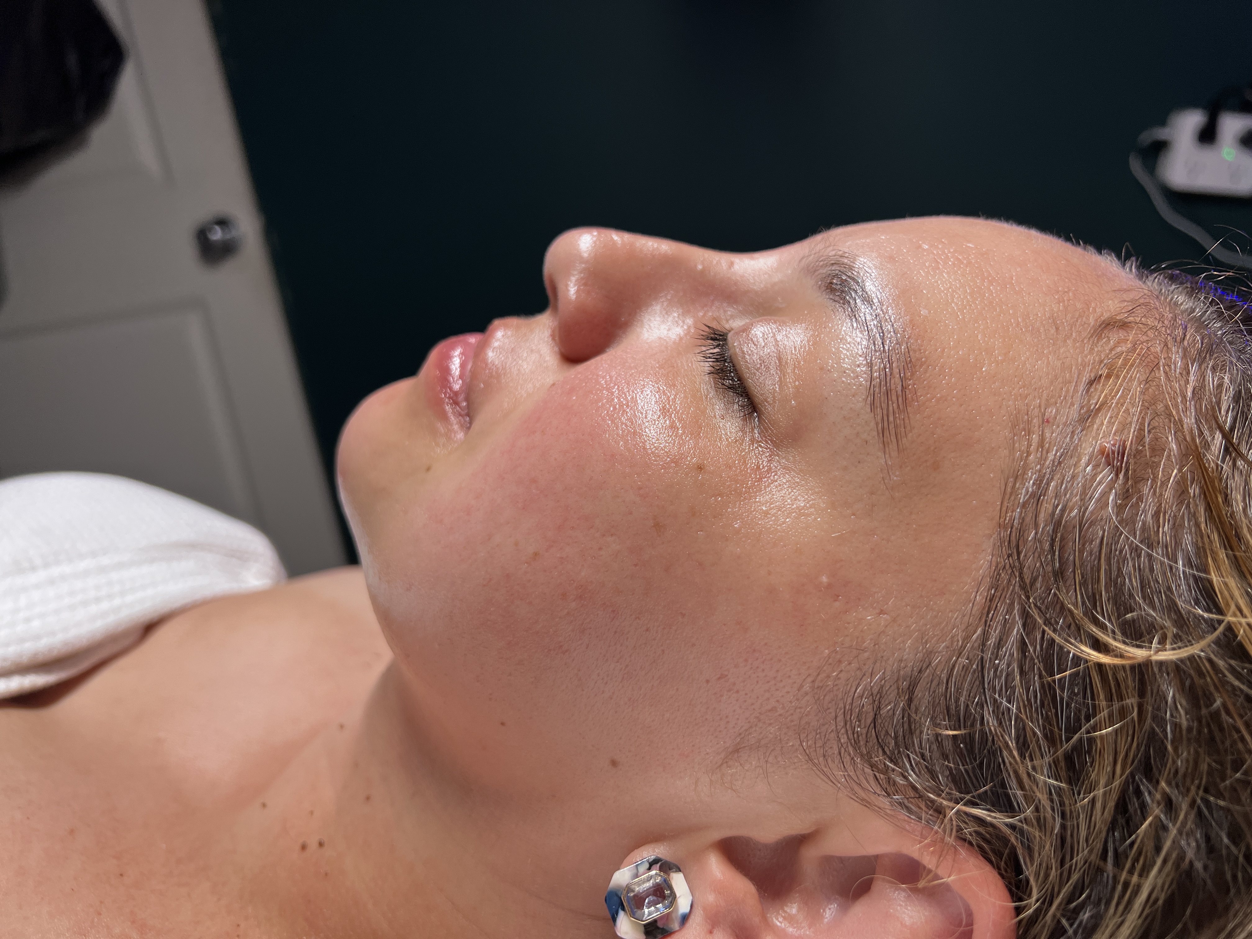 Hydrodermabrasion facial