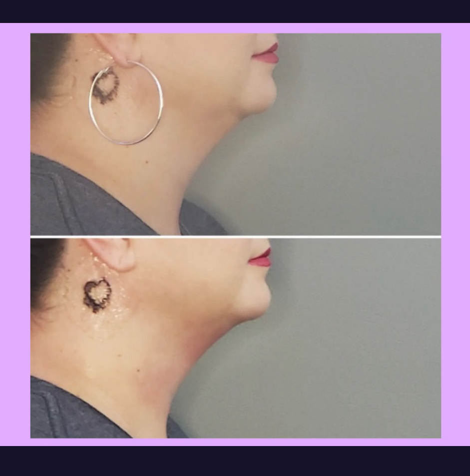 Chin/Jawline/Neck Sculpting