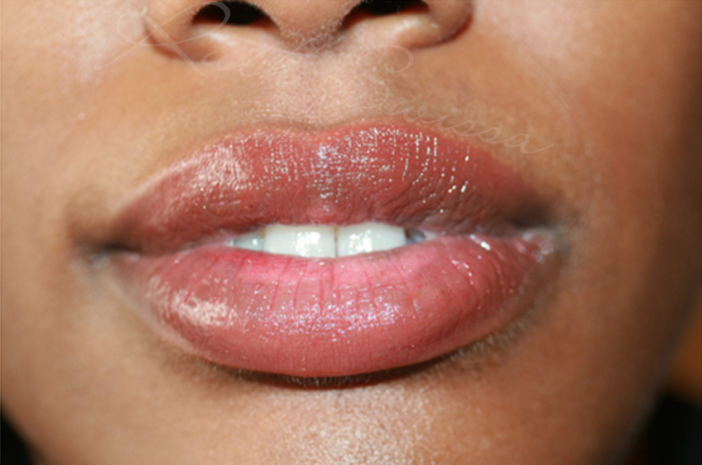 Lips (Neutralize Melanin Rich Lips)