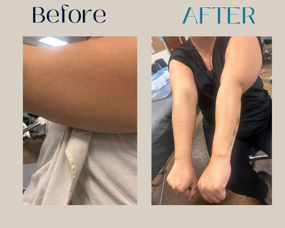 Body Peel