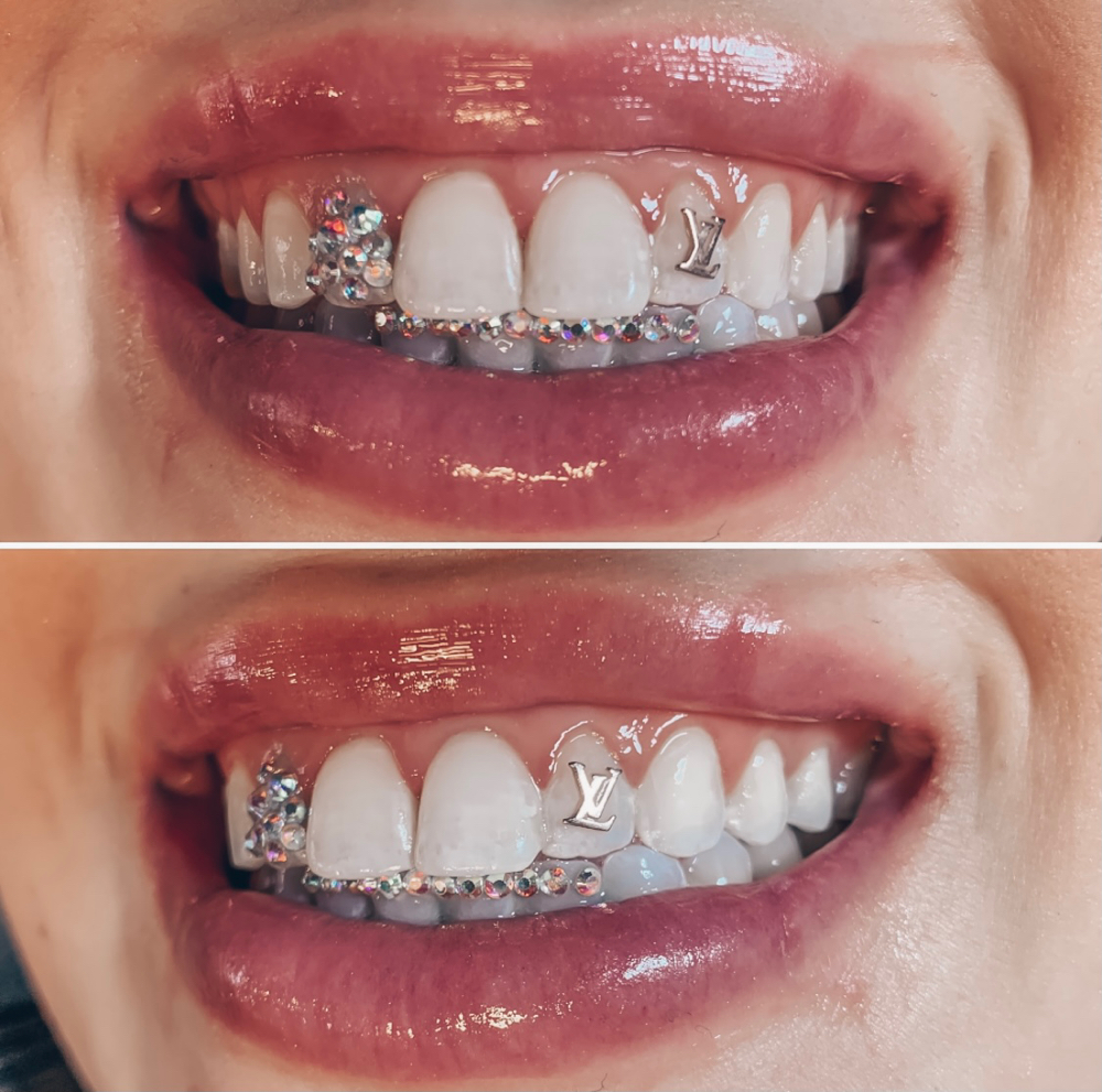 Ice Treatment Faux Grillz at Manifest Management LLC in Spokane, WA