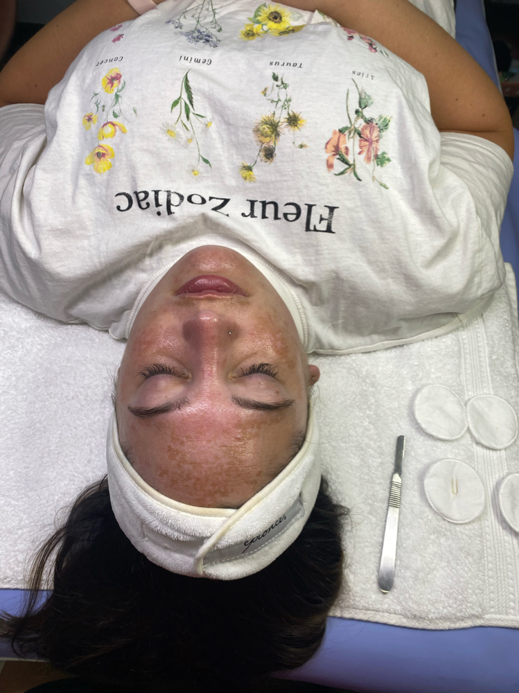 Dermaplaning Facial