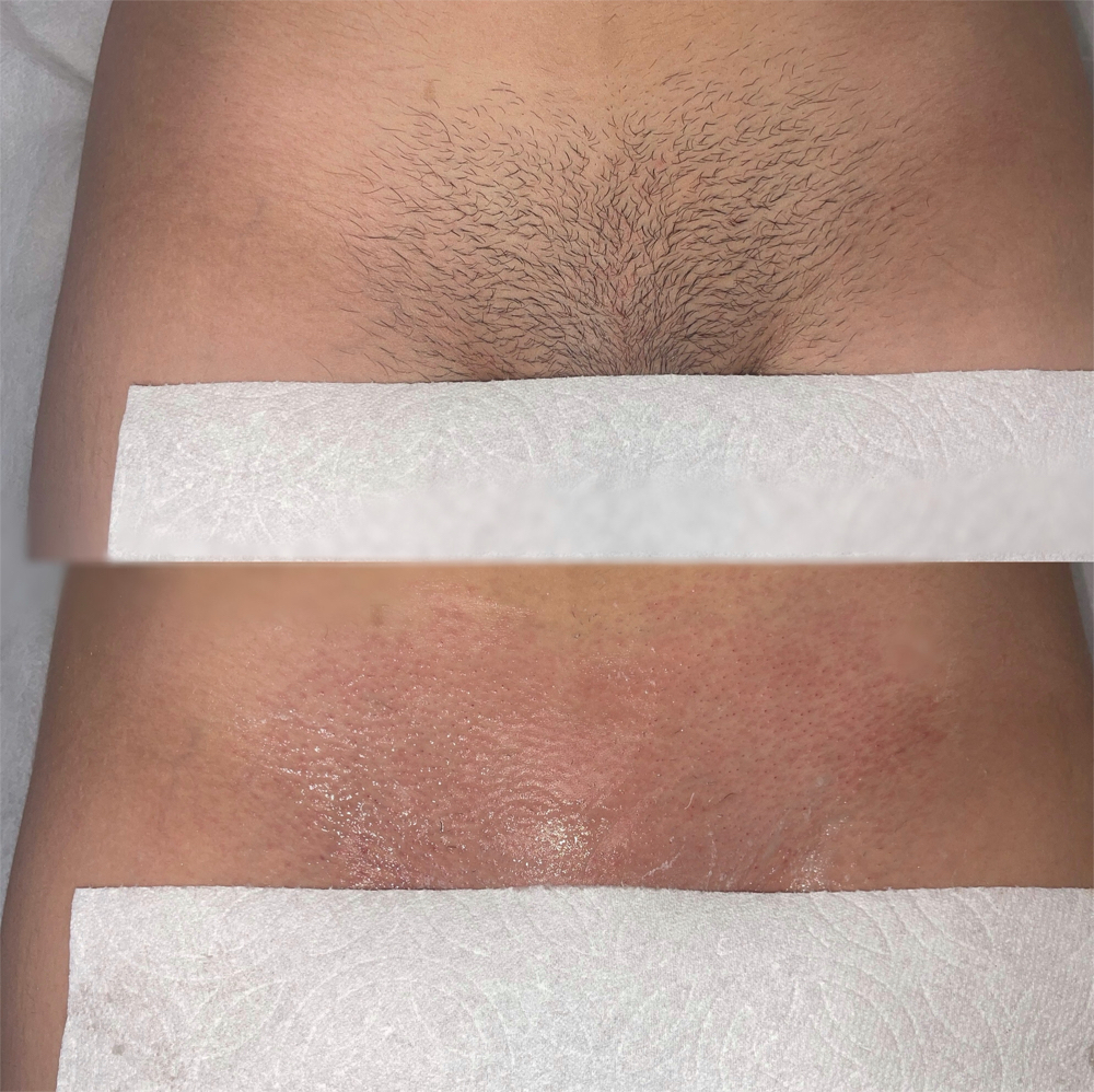 Brazilian Wax