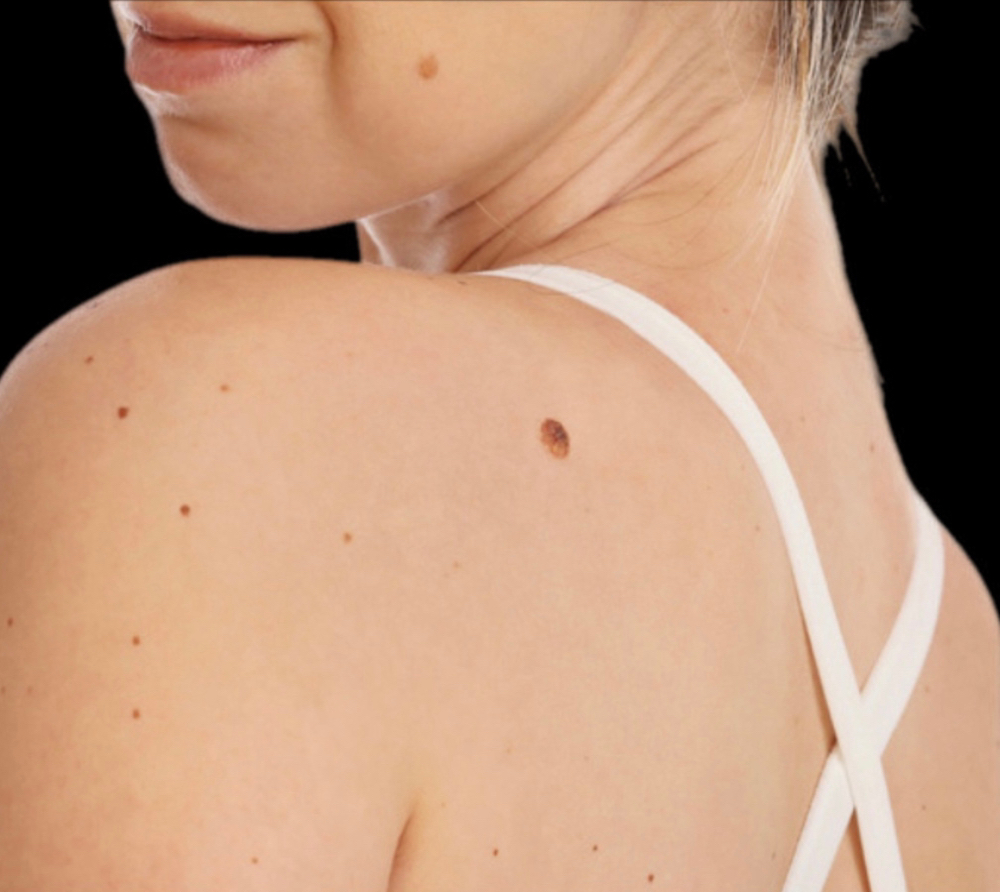 SKIN IMPERFECTION REMOVAL