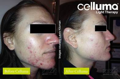 Celluma Acne Treatment