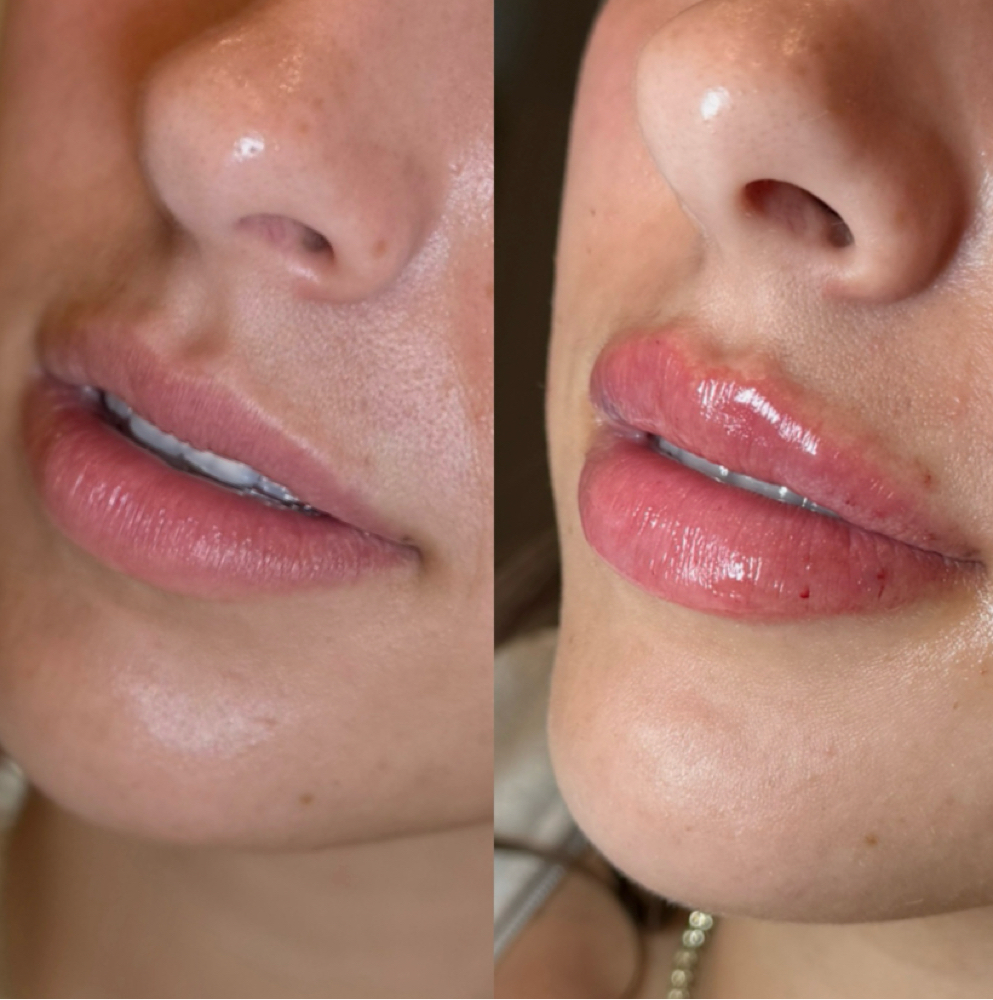 LACE Lips at Lace Skn in West Lake Hills, TX