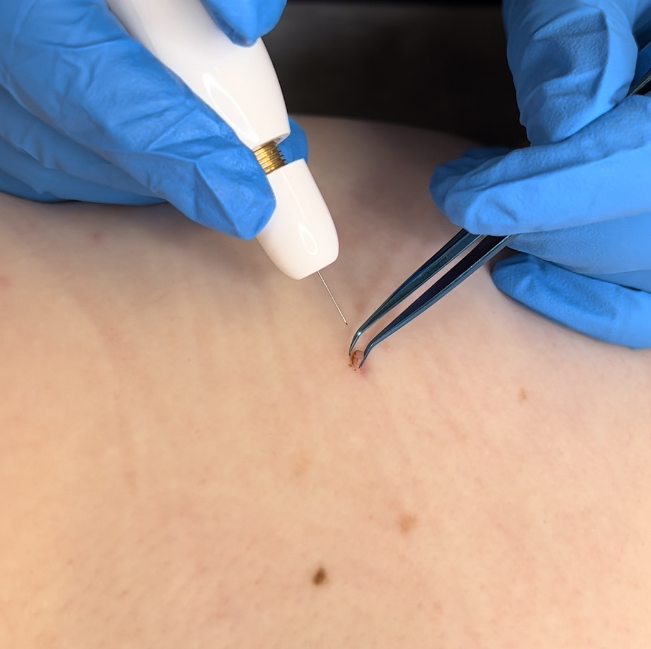 Skin Tag Removal