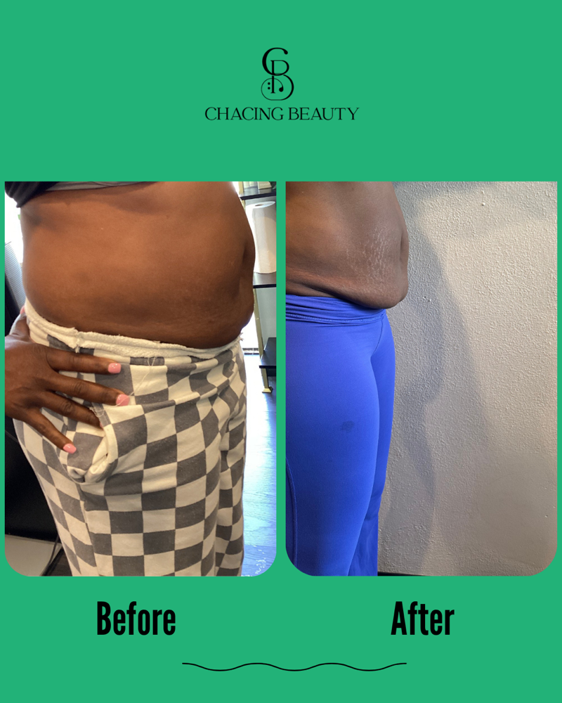Liquid Lipo | Standard Session at Chacing Beauty in Dayton, OH