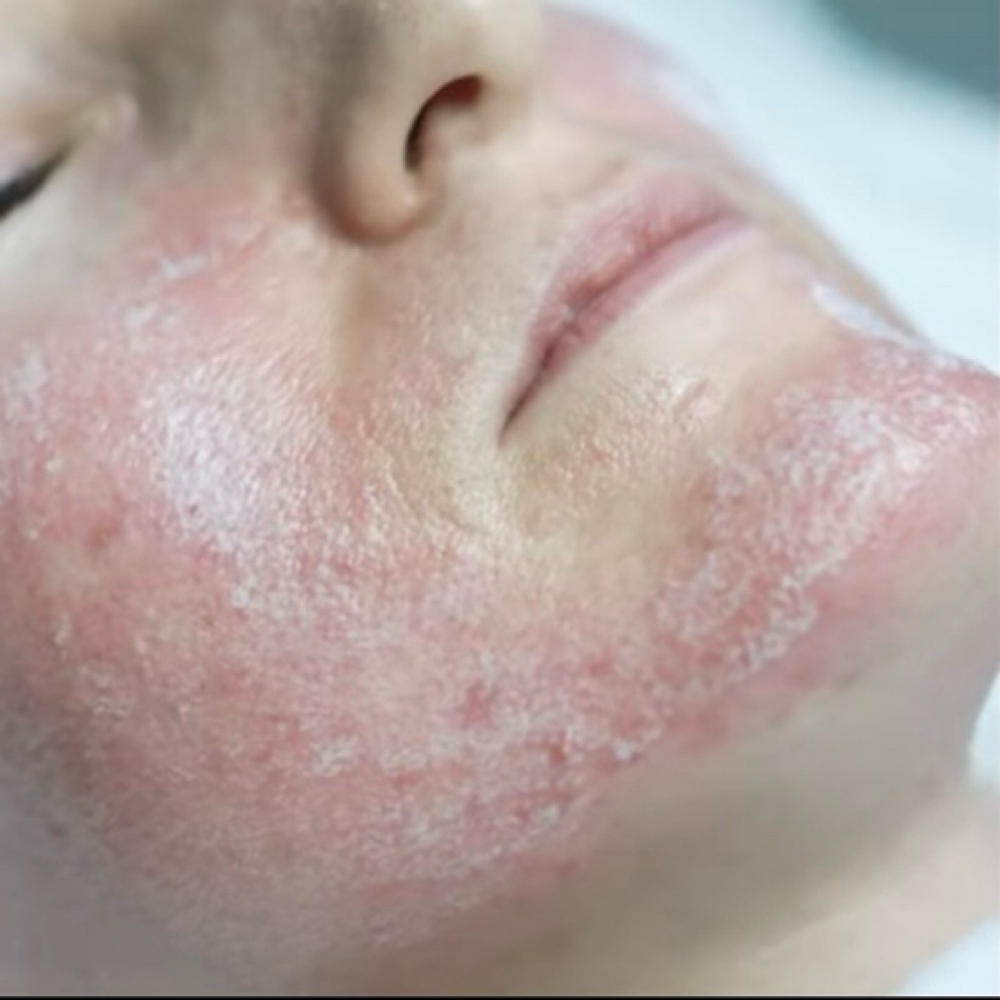PARAMEDICAL VIP Peel at Face&Body Studio in Clearwater, FL