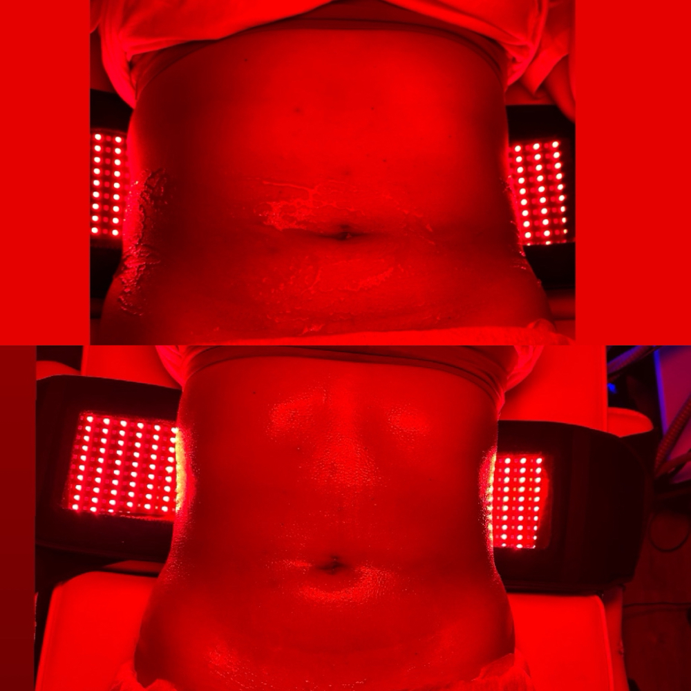 Brazilian Lymphatic Drainage