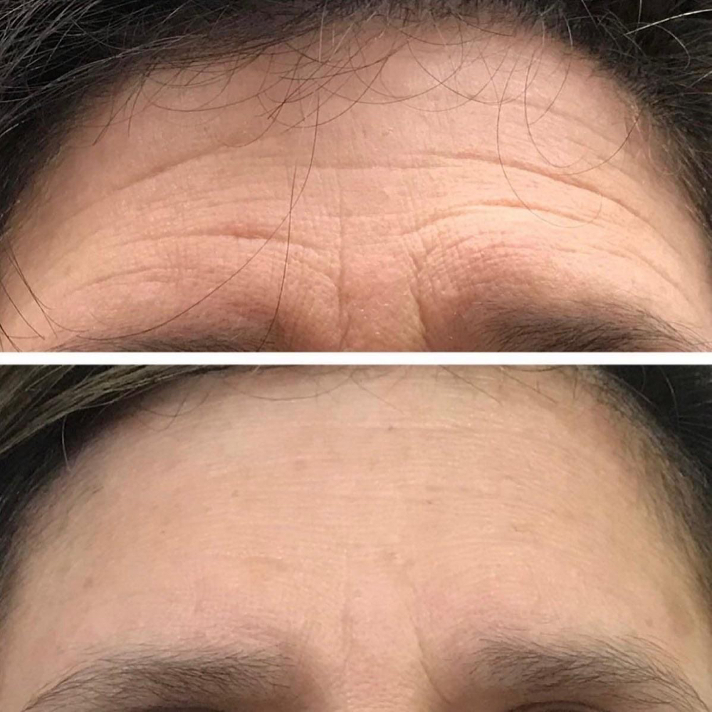 Microneedling Package(3 Treatments)