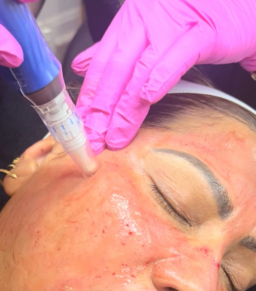 Microneedling + Growth Factor