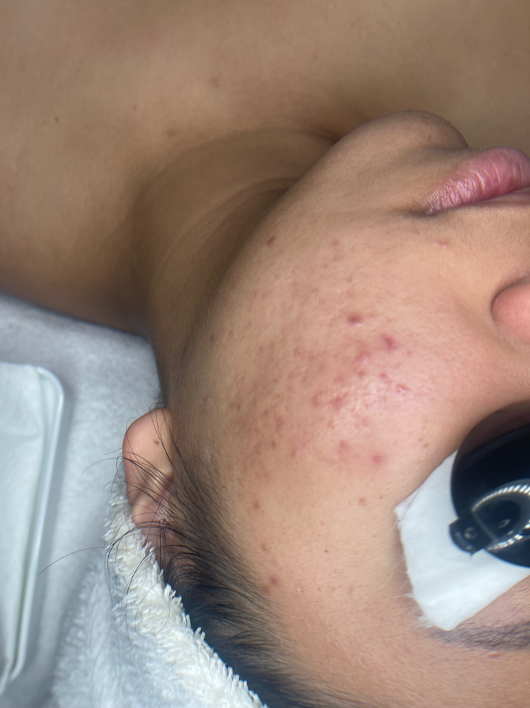 Bye Bye Bye Breakout Facial