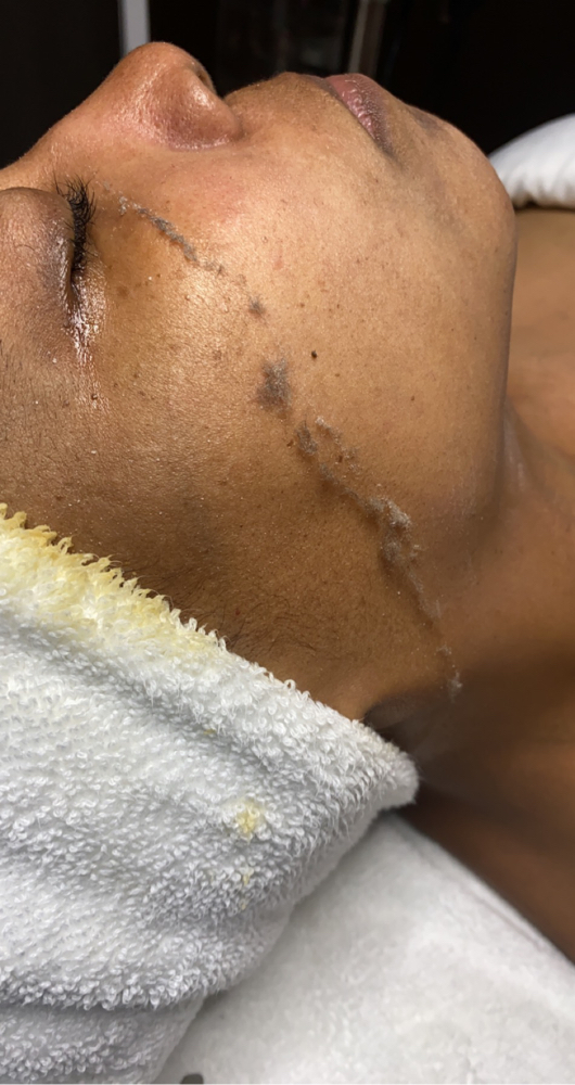 Dermaplane