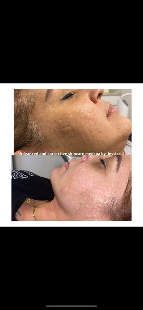 Microneedling Solo Session at Advanced Skincare & Laser By Jess in Naples, FL