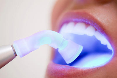 Luxury Teeth Whiteing