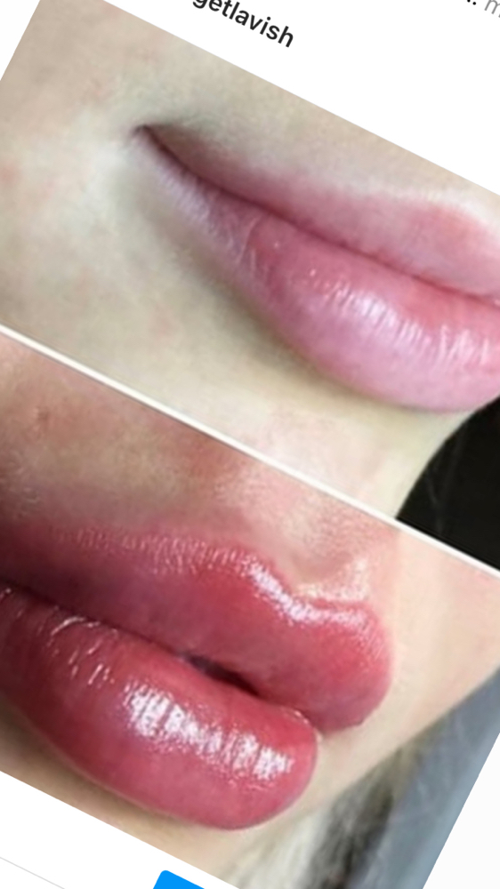 Lip Fillers - No Needle