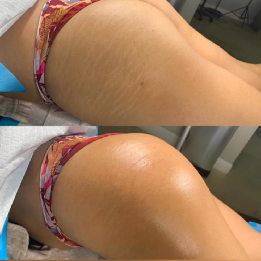 Scar camouflage at Cosmetic Artistry in Lancaster, CA