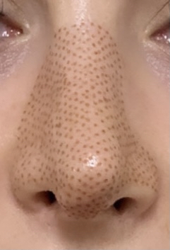 Nose Contour Plasma Lift