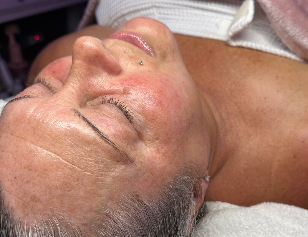 Glycolic Peel Facial