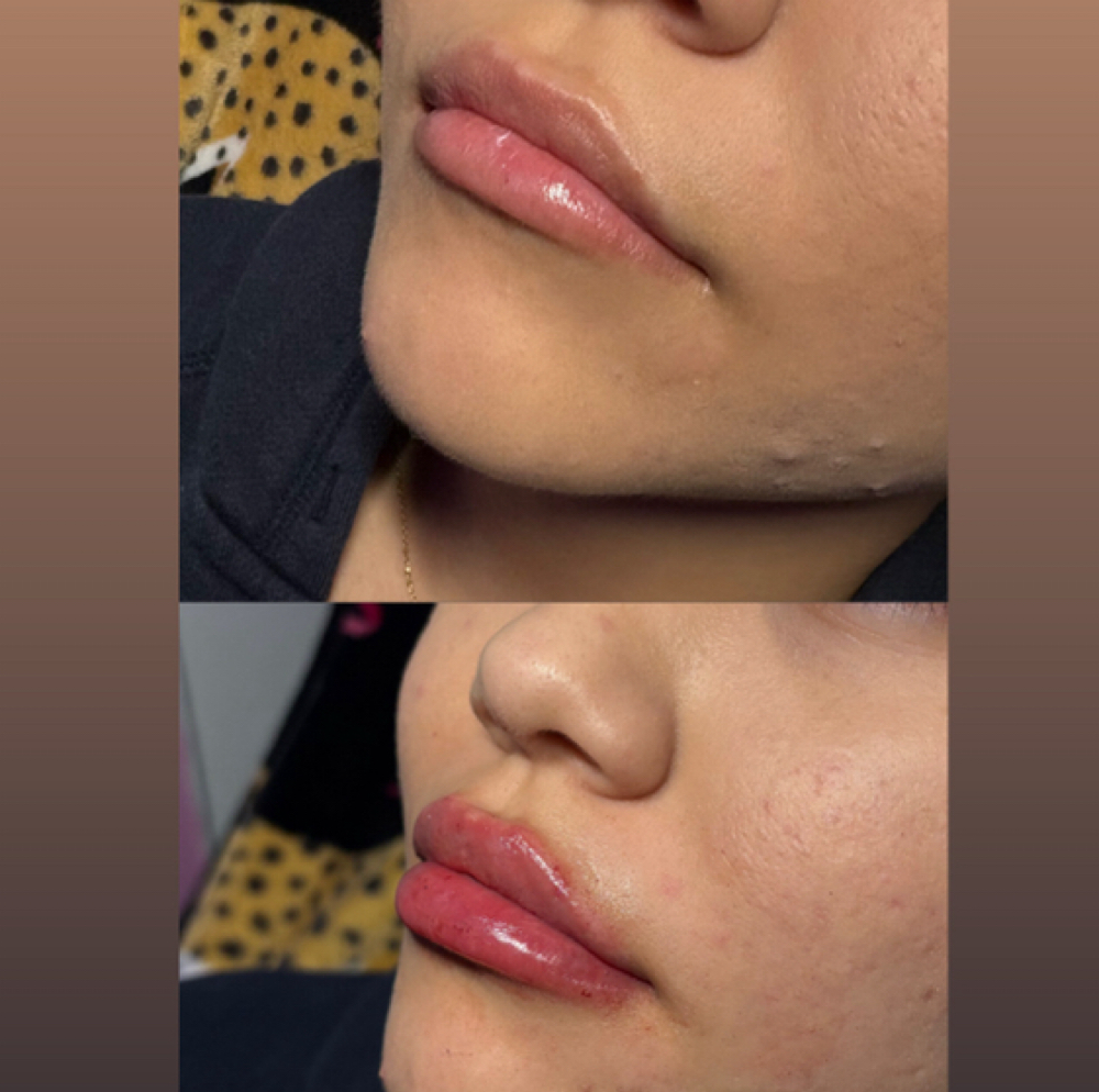 Lip Filler 1.5 ML at Studios Secrets in Dallas, TX