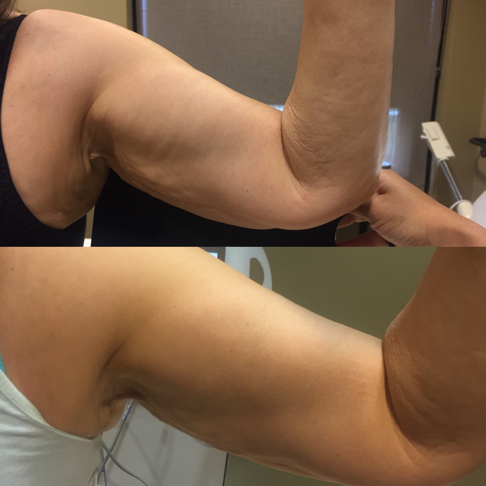 Skin Tightening (Arms)