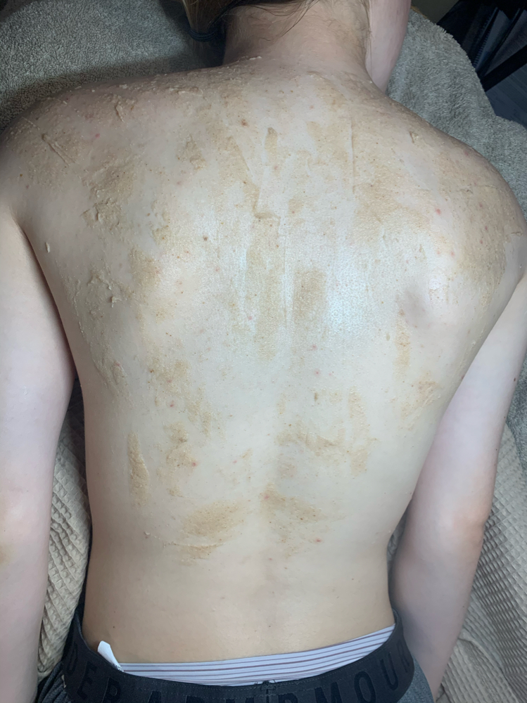 Back Treatment