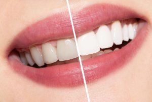 Teeth Reversal