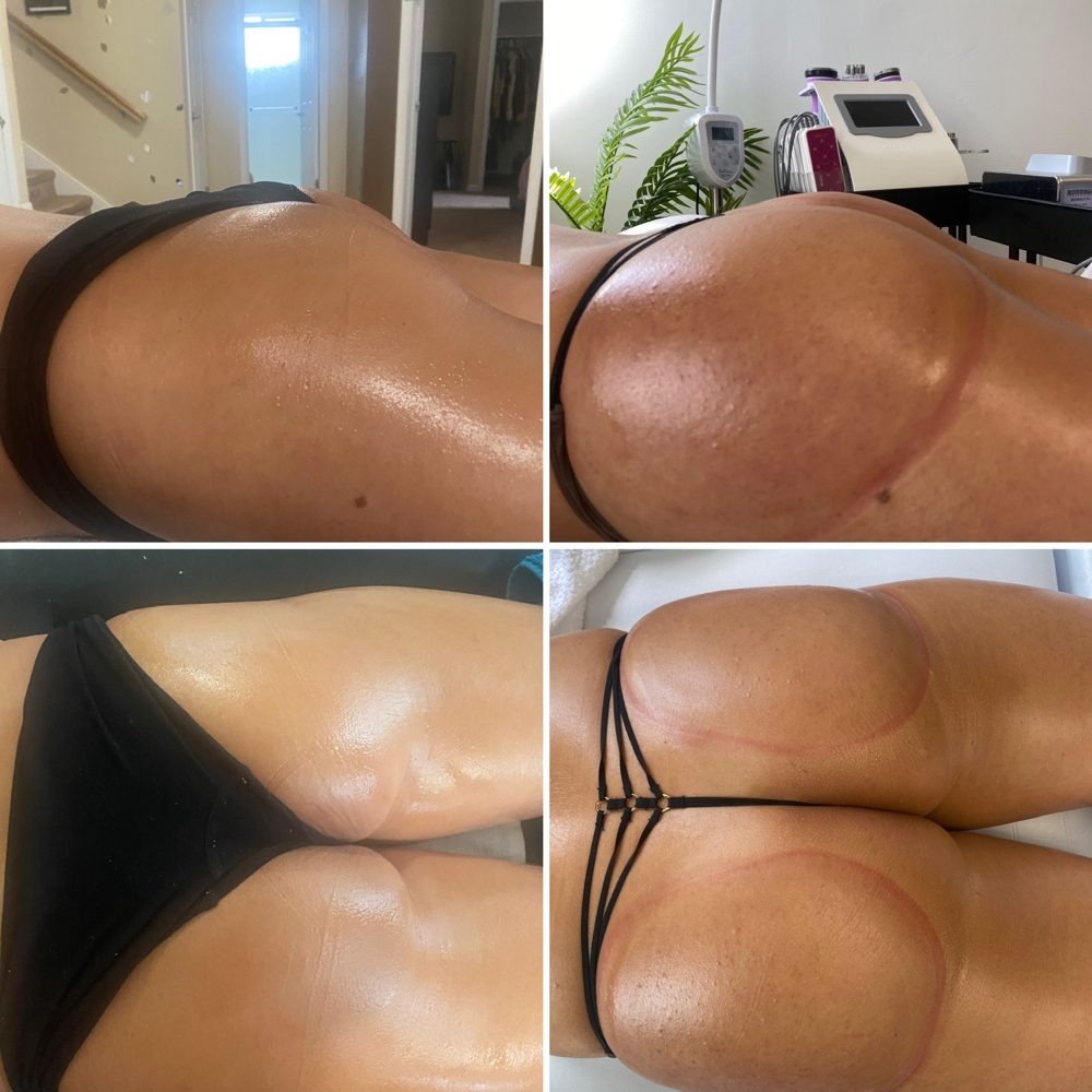 30 Minute Vacuum Butt Lift Therapy