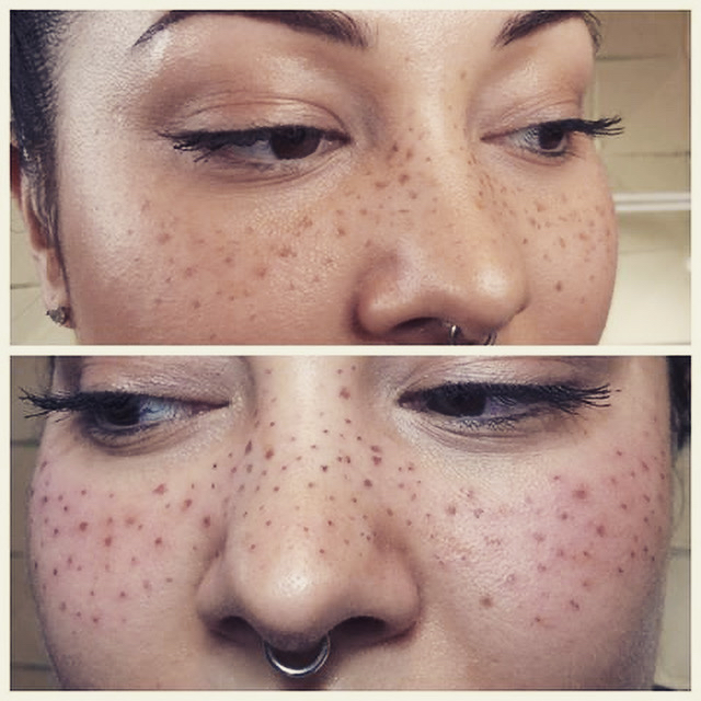 Freckles Consultation at Manifest Management LLC in Spokane, WA
