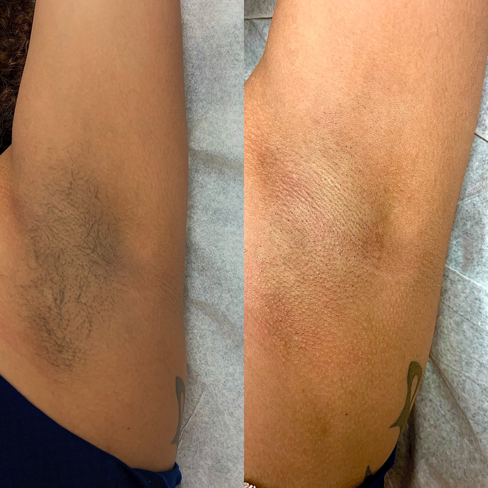 Armpit Wax at BareSkin in Port Allen, LA