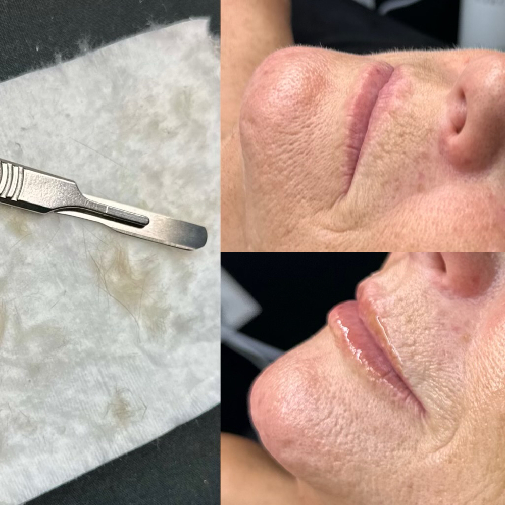 Dermaplaning Facial