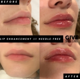 Lip Enhancement