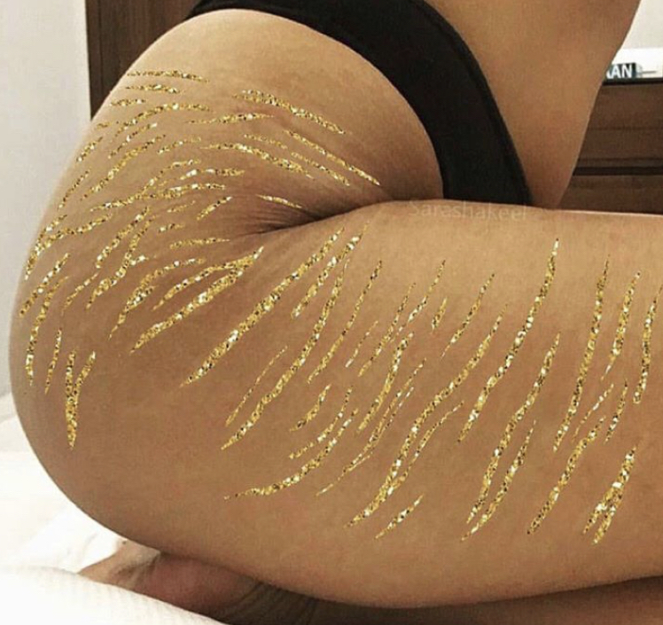 Stretchmark, Scar & Burn Camouflage