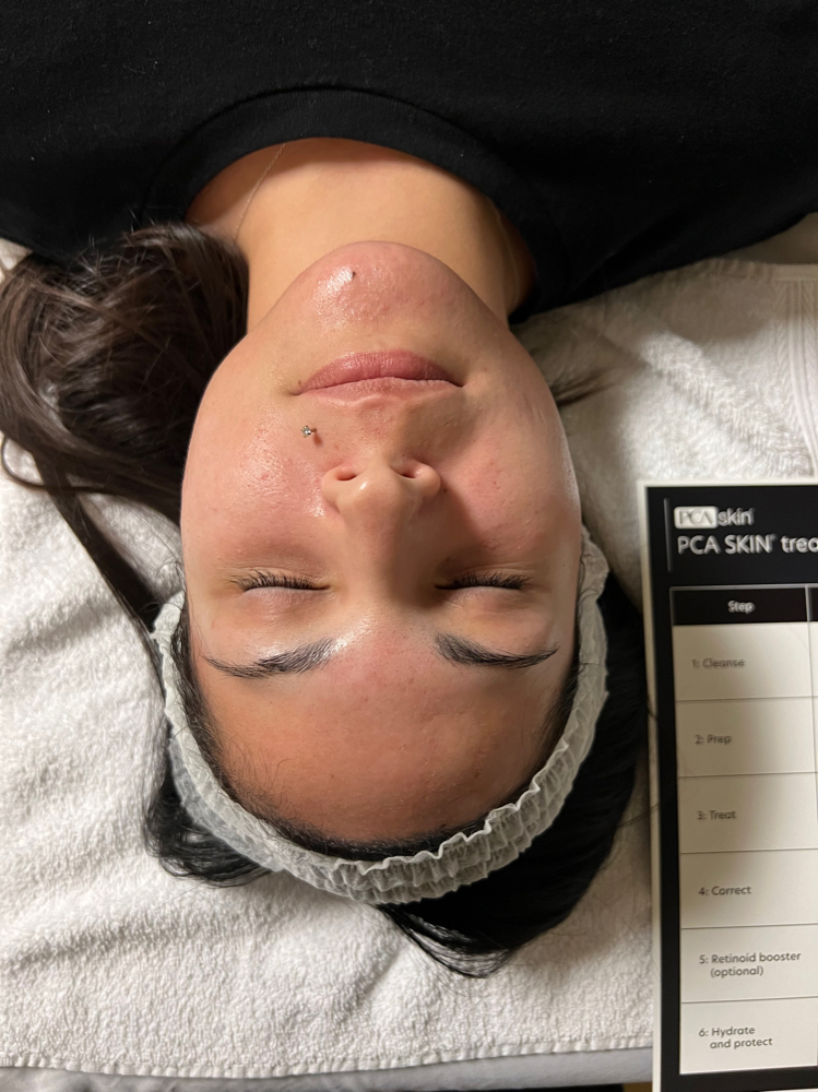 Chemical Peel Facial