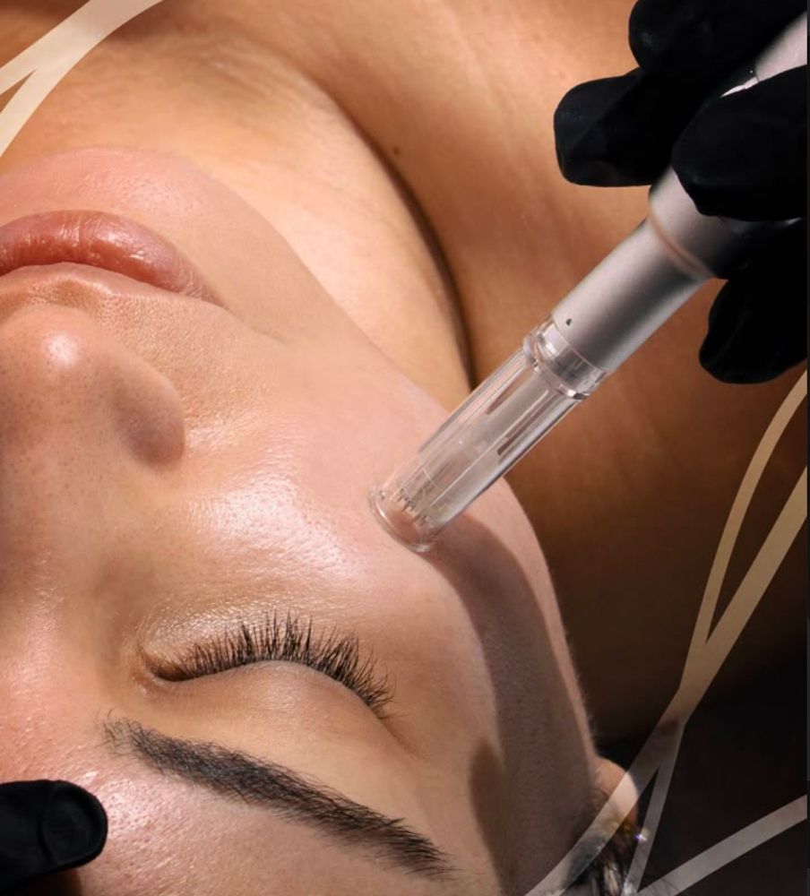 Microneedling