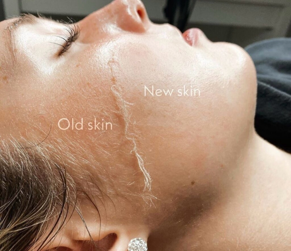 Advanced Dermaplaning at Skintique by lacey in Dayton, OH
