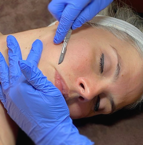 DERMAPLANE W/ CHEMICAL PEEL