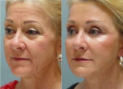 MICROCURRENT AGE DEFYING FACIAL