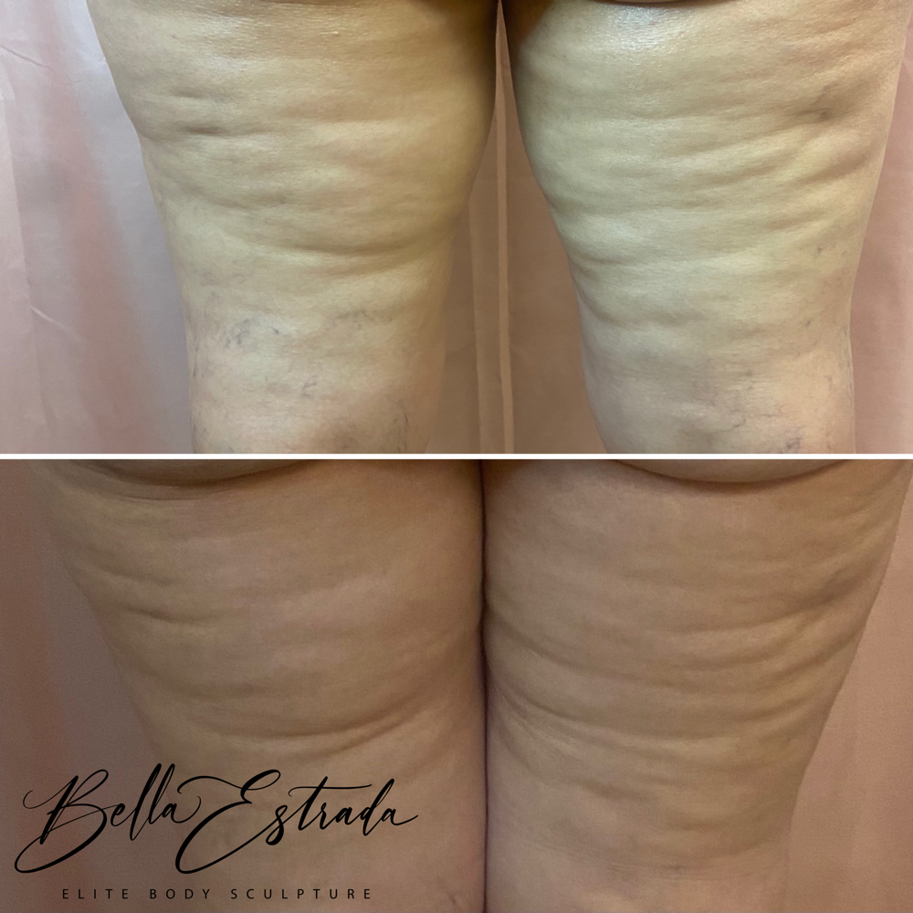 Cellulite Reduction ProCell